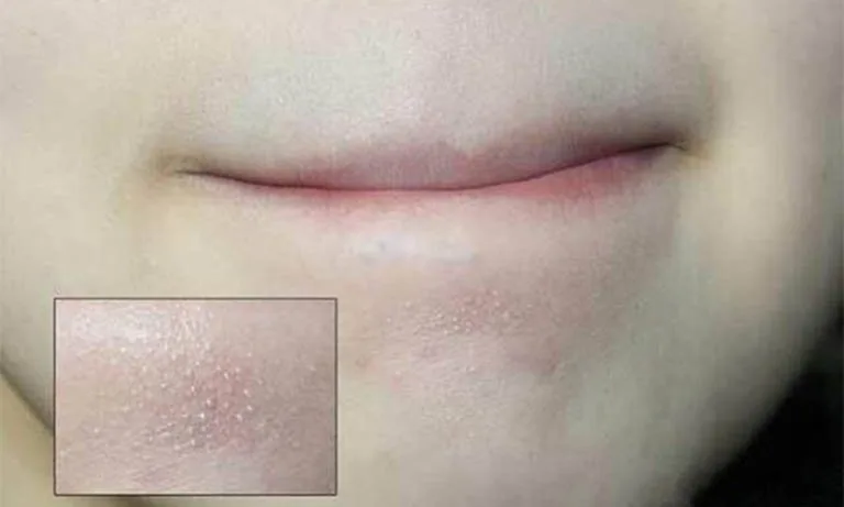 20210615 152309 176350 nguyen nhan gay nen m.max 800x800 1