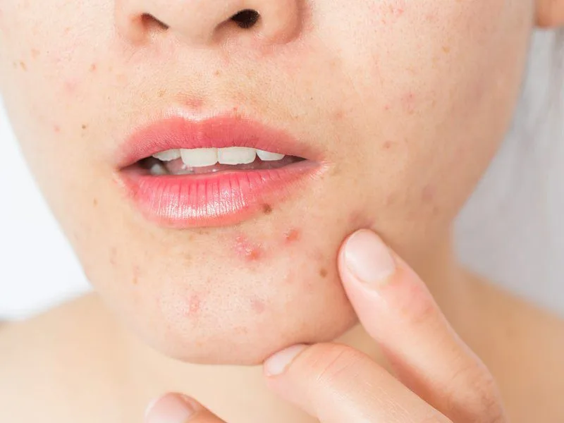 20221108 020424 394329 cach tri mun noi tiet.max 800x800 1