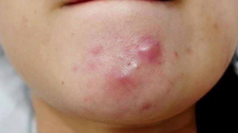 20230117 023346 169958 tri mun nang.max 800x800 1