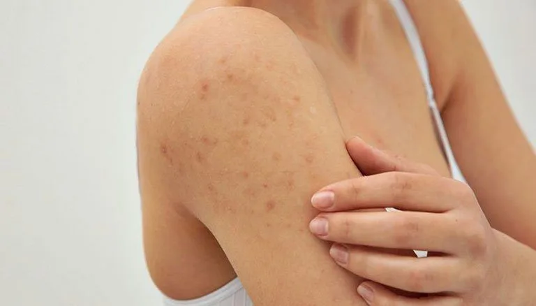 20230119 023244 383799 noi mun tren canh tay.max 800x800 1