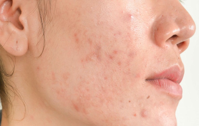 Kem trộn và 3 điều cần biết 3 viem da di ung