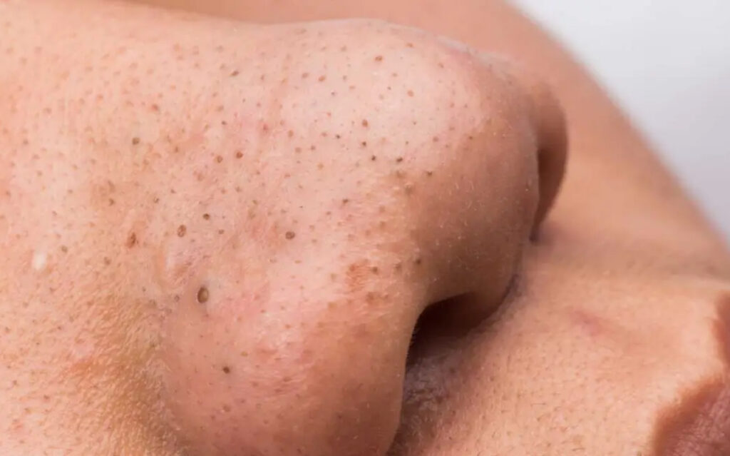blackhead