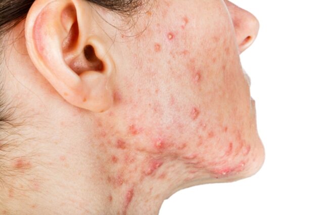 cystic acne - Mỹ phẩm sinh học - Drbelter Việt Nam