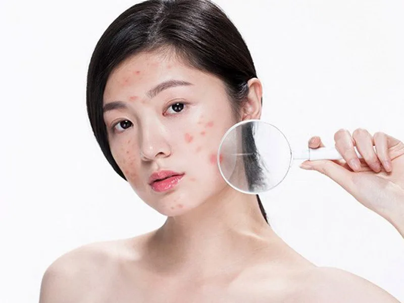 thuoc tri mun tuoi day thi 2