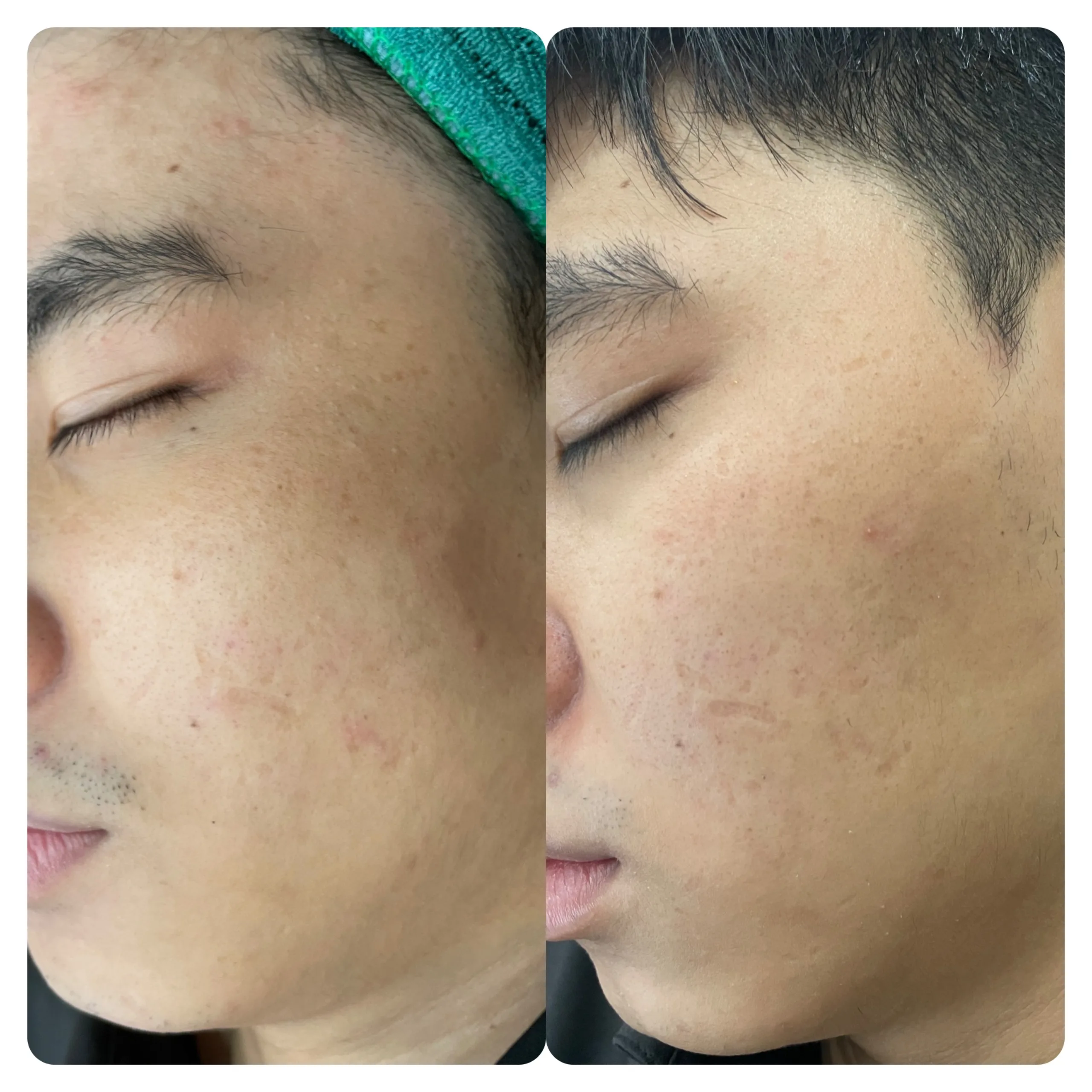 Peel tren da dau mun sau 5 ngay 6