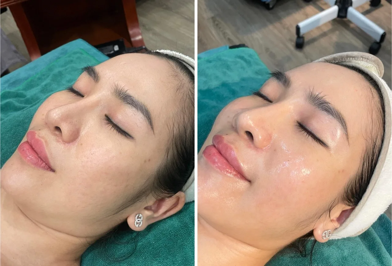 Cap am cang bong sau 1 lan 3